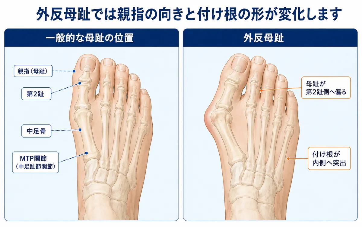 一般的な母趾と外反母趾で親指の向きと付け根の突出を比較した図