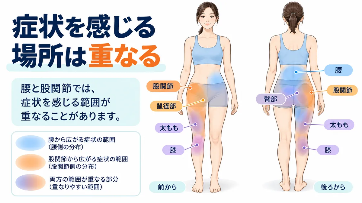 腰・臀部・鼠径部・股関節・太ももなど症状を感じる範囲が重なることを示す図
