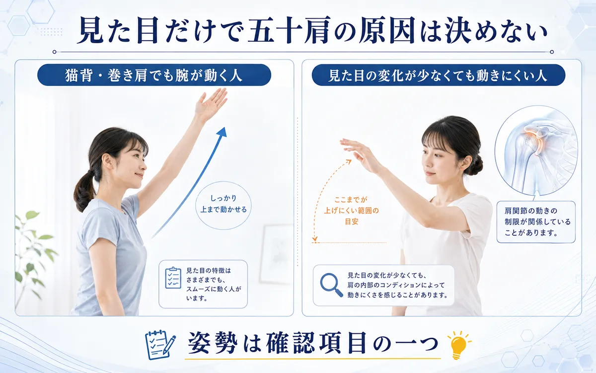 猫背や巻き肩の見た目だけでは五十肩の原因を判断できないことを示す比較図