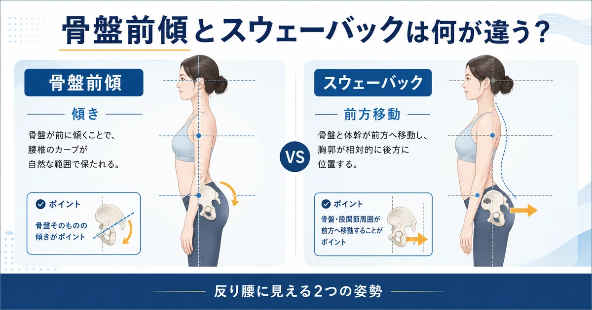 骨盤前傾とスウェーバックの違いを横から比較した反り腰姿勢の図