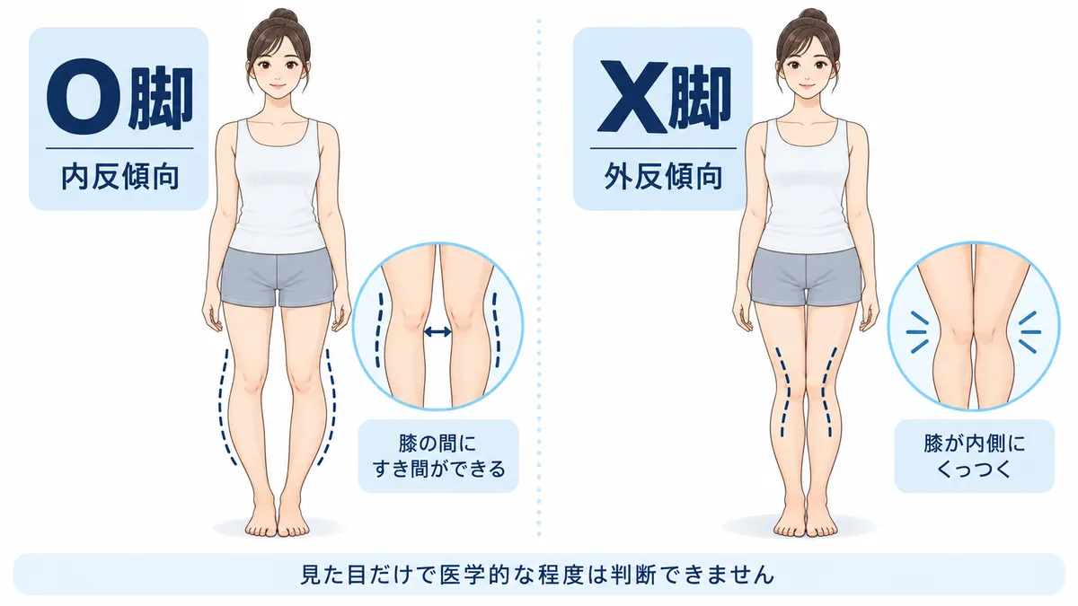 O脚の内反傾向とX脚の外反傾向を正面から比較した図