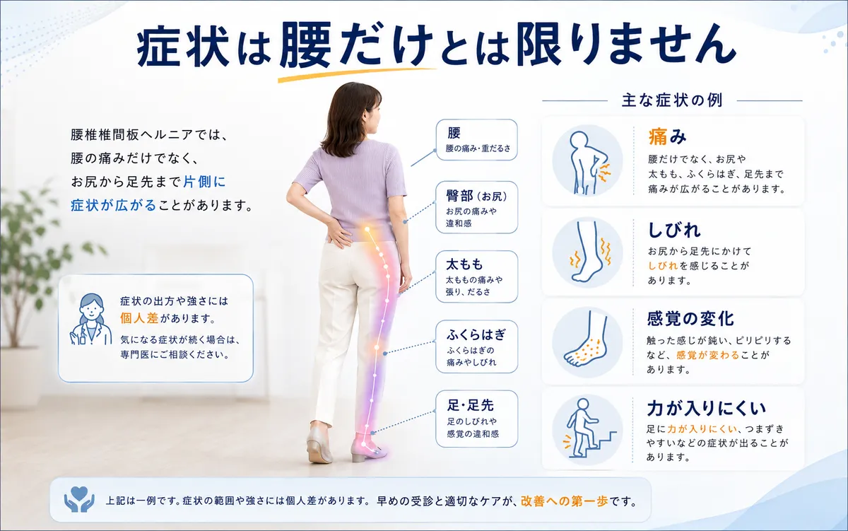 腰椎椎間板ヘルニアで腰から臀部、太もも、ふくらはぎ、足へ症状が広がるイメージ