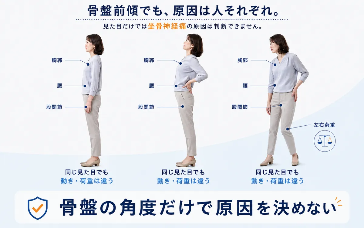 坐骨神経痛の原因整理と姿勢・股関節・動作の評価を分けて考える図