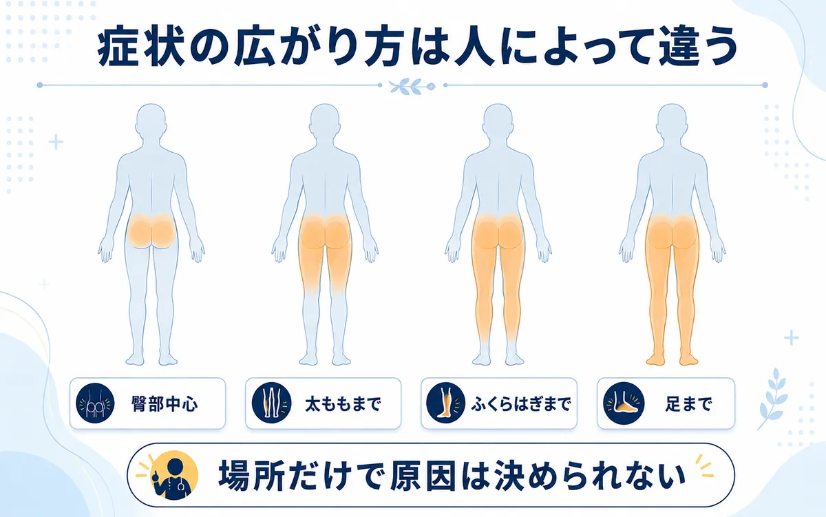 臀部から太もも・ふくらはぎ・足まで症状が広がる範囲には個人差があることを示す図