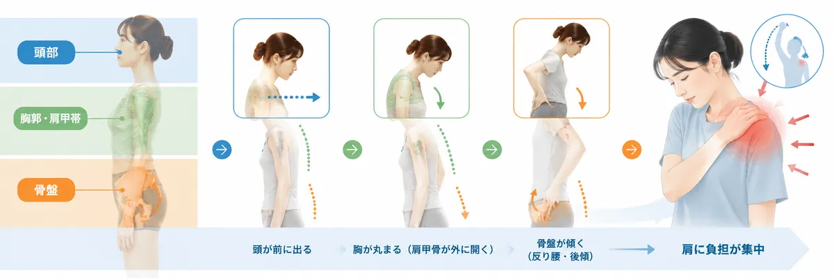 頭部・胸郭肩甲帯・骨盤の姿勢変化によって肩に負担が集まる一例