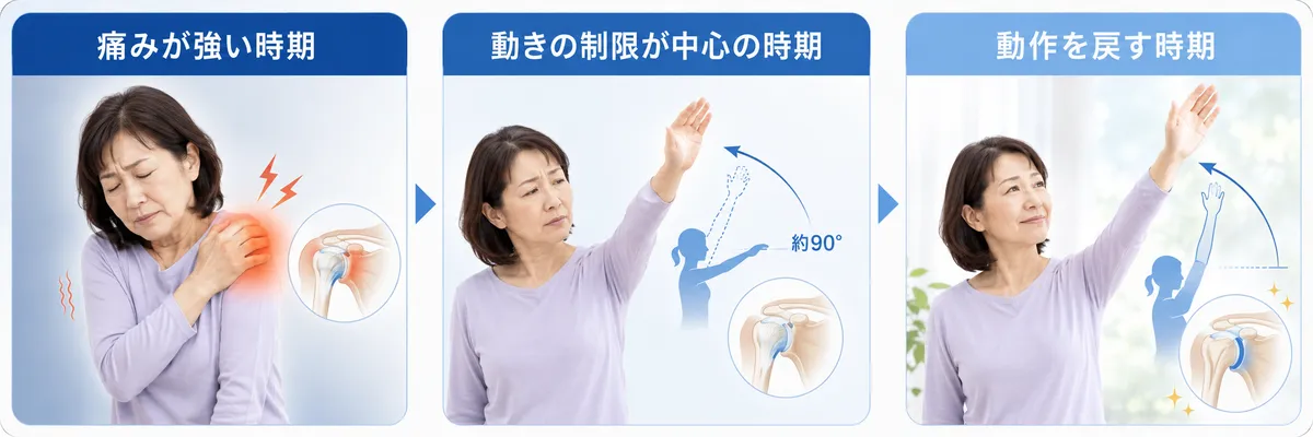 五十肩の痛みが強い時期・動きが制限される時期・動作を戻す時期