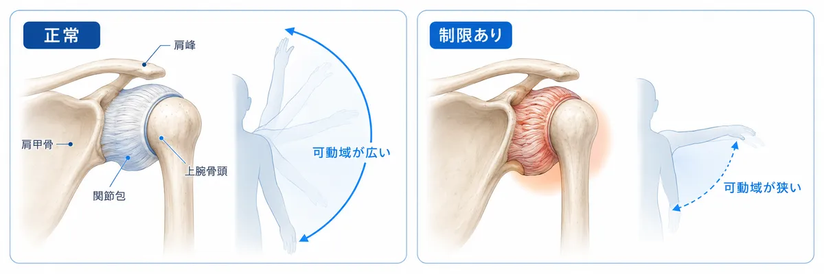 正常な肩関節と五十肩で可動域が制限された肩の比較図