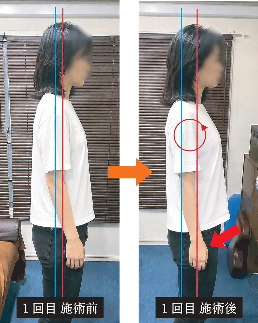 CASE4の施術前後の姿勢比較