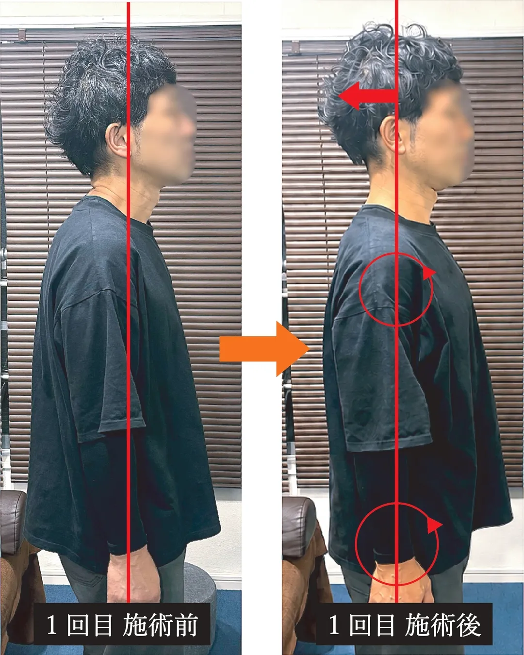 CASE5の施術前後の姿勢比較