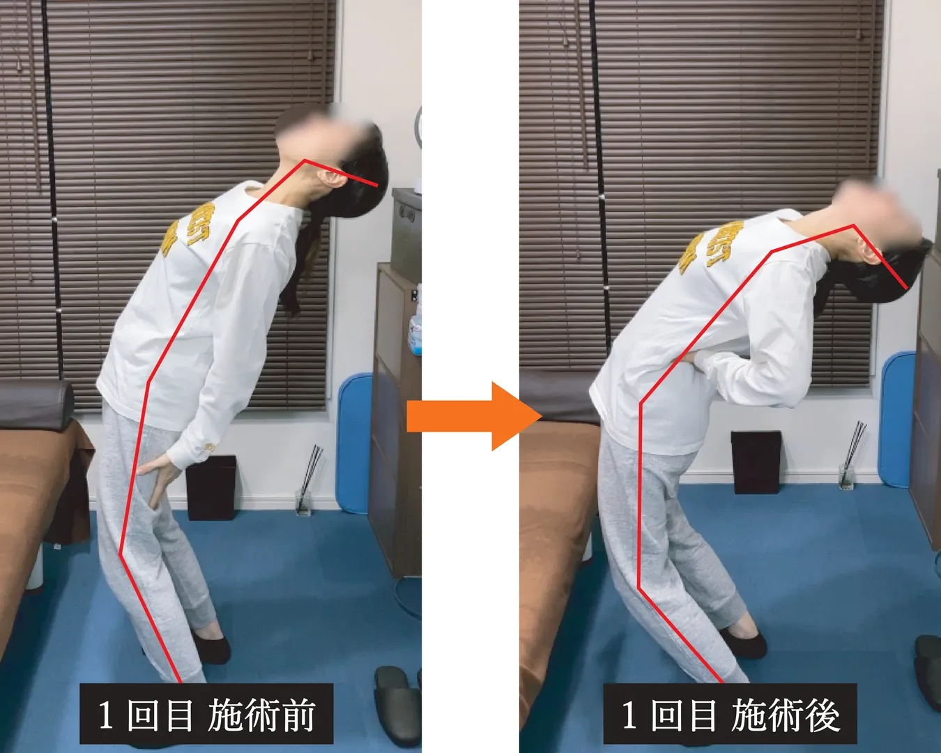 背屈での可動域と痛み、左足に響く坐骨神経痛の施術前後比較