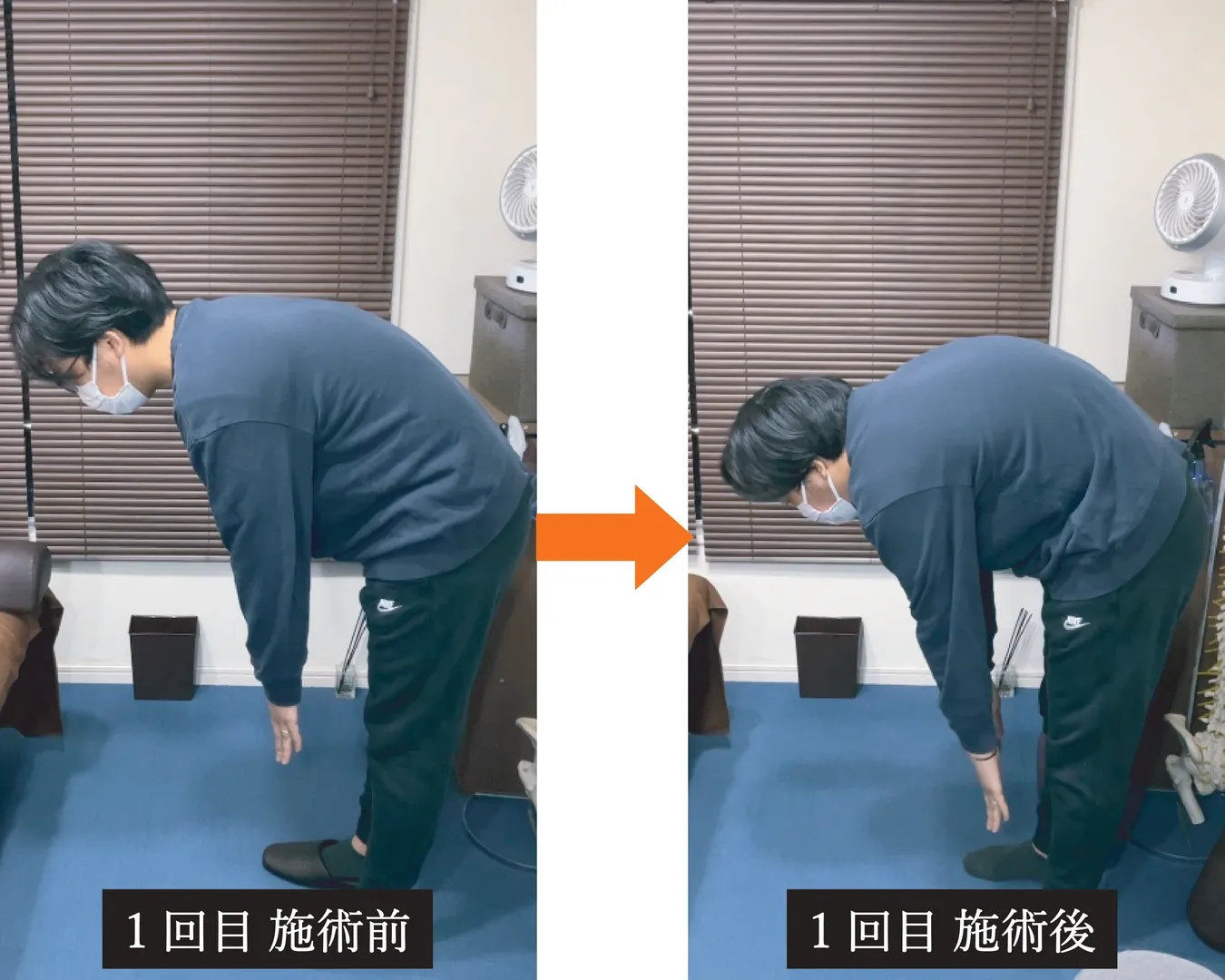 ギックリ腰の痛みと前屈可動域の施術前後比較
