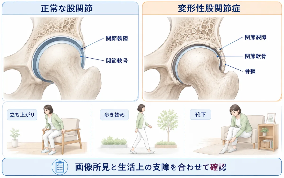 股関節内の軟骨や関節唇と関節周辺の筋肉、腱、滑液包の違い