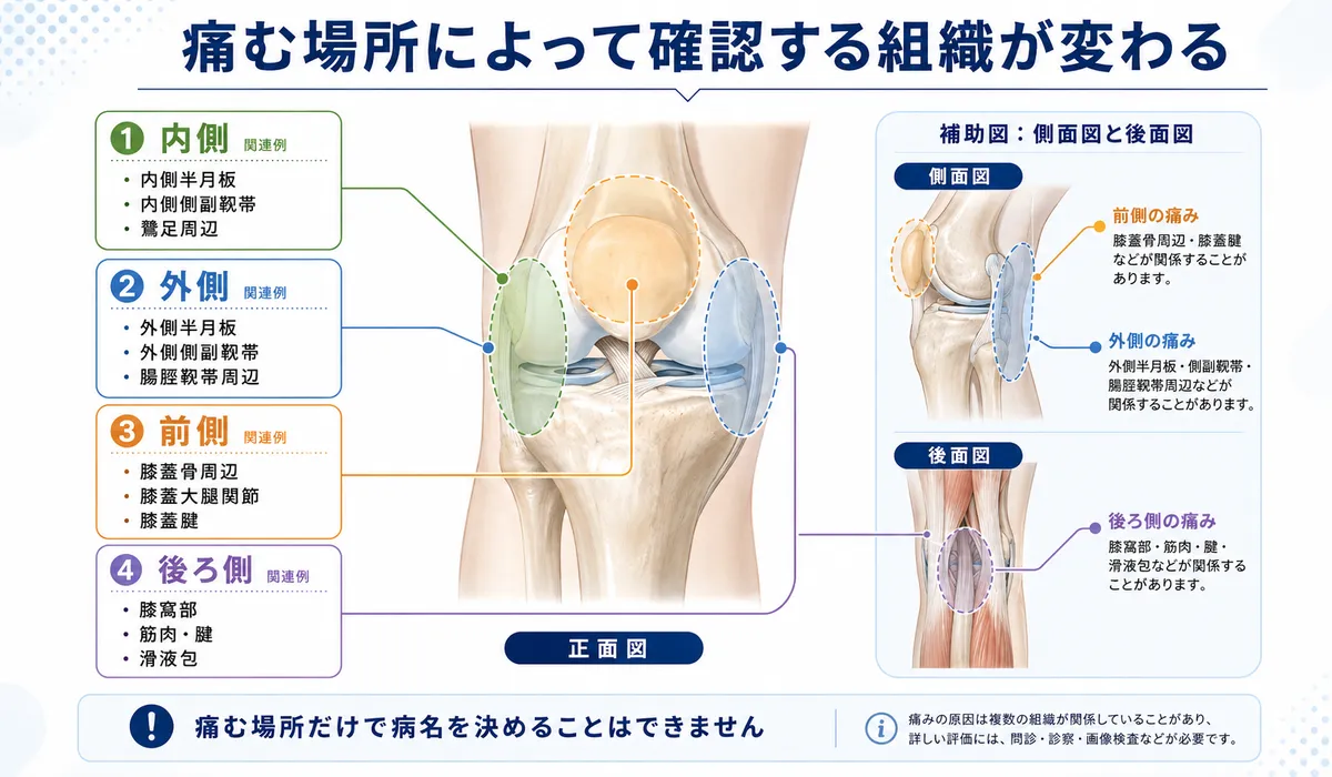 膝の内側・外側・前側・後ろ側の痛みと関連する組織