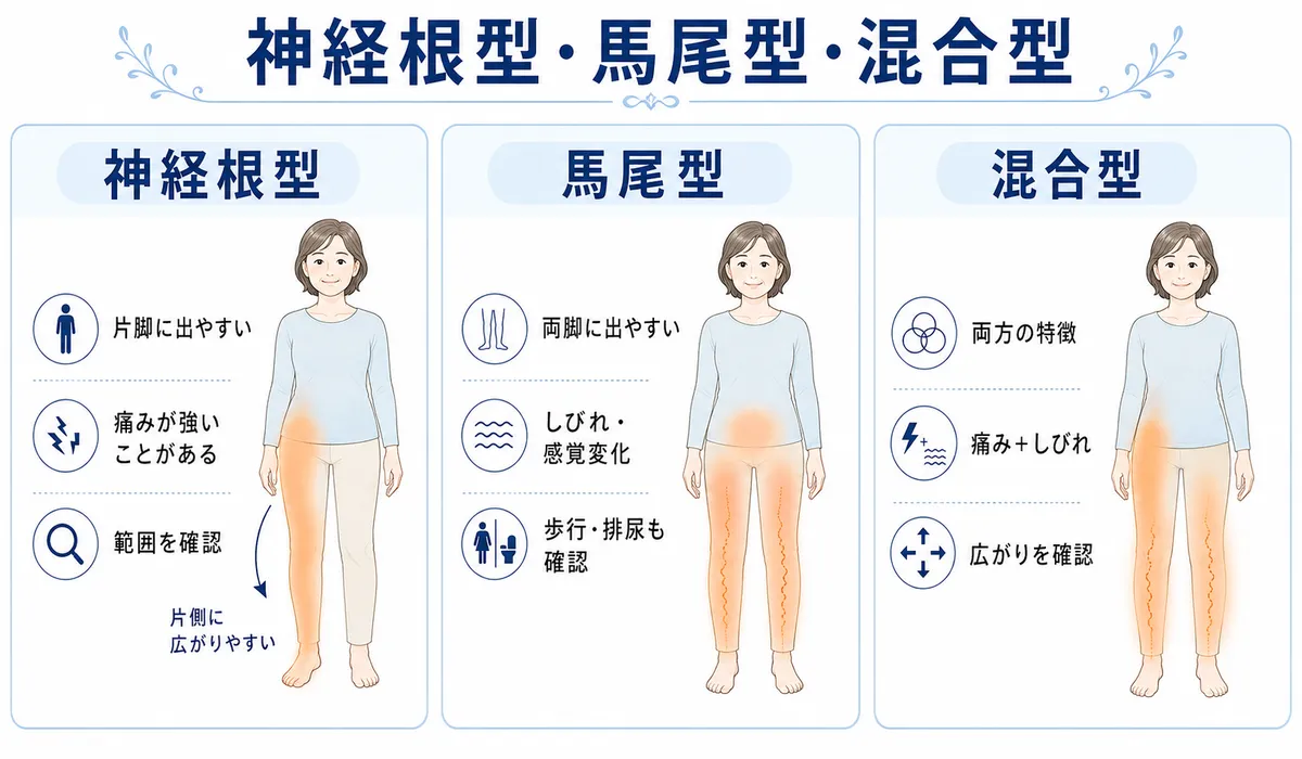 神経根型と馬尾型と混合型の特徴の違いを3列で比較した図解