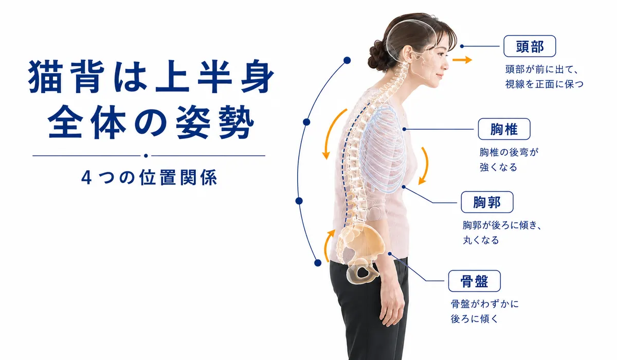 頭部、胸椎、胸郭、骨盤の位置関係から猫背が形成される様子を示した図解
