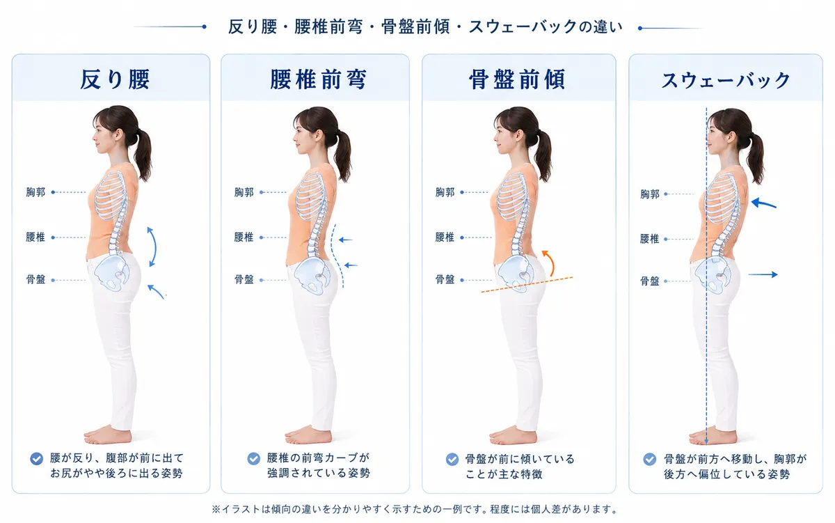 反り腰と腰椎前弯と骨盤前傾とスウェーバックの違いを同じ女性で比較した図解