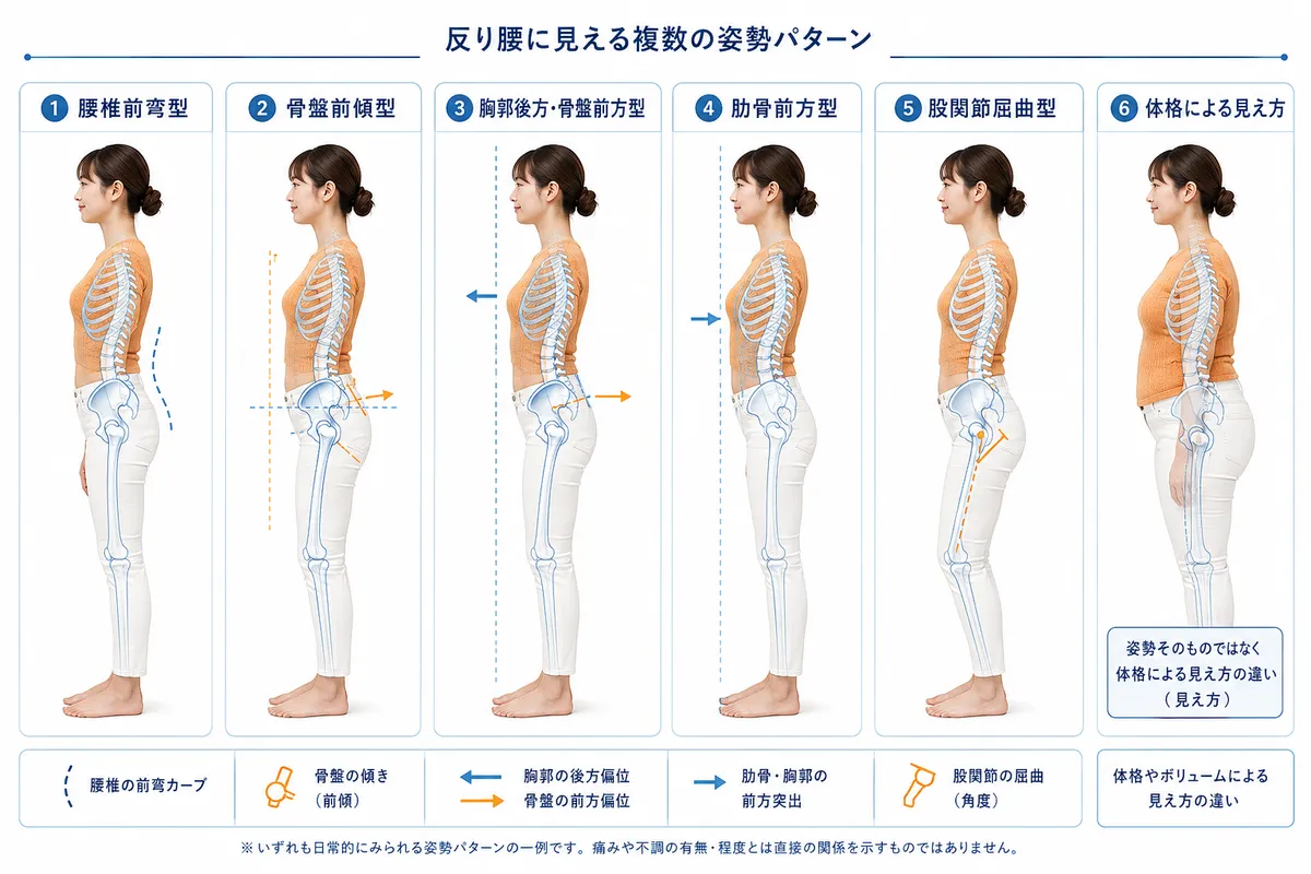 反り腰に見える6種類の代表的な姿勢パターンを比較した図解