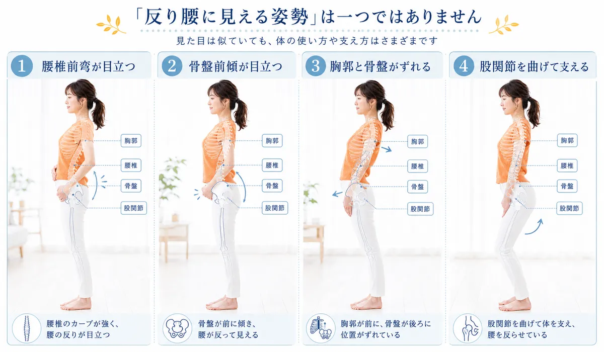 反り腰に見える代表的な4つの立ち方の違いを比較した図解