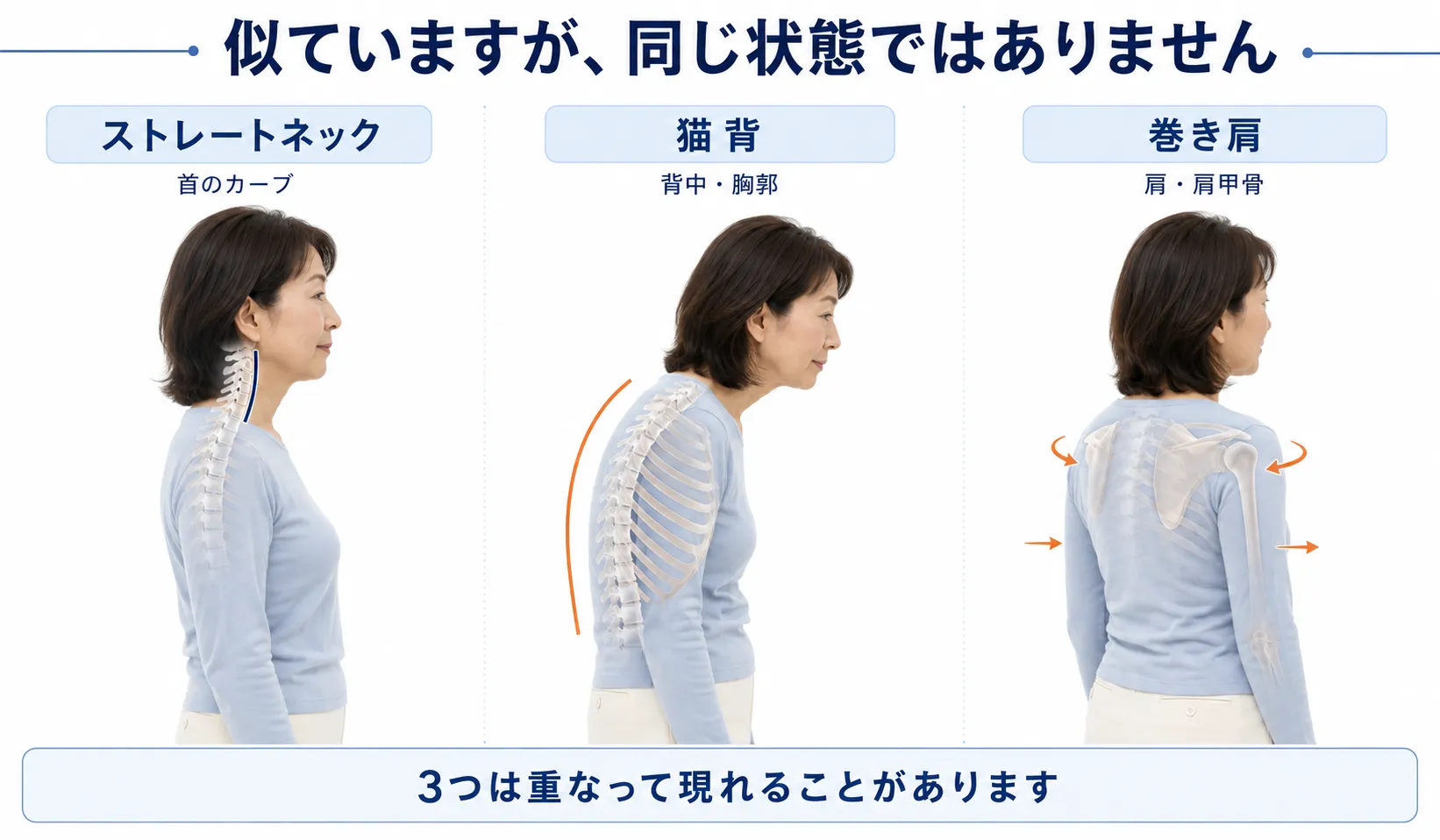 ストレートネック・猫背・巻き肩の違いを首・胸郭・肩甲骨の位置で比較した図解
